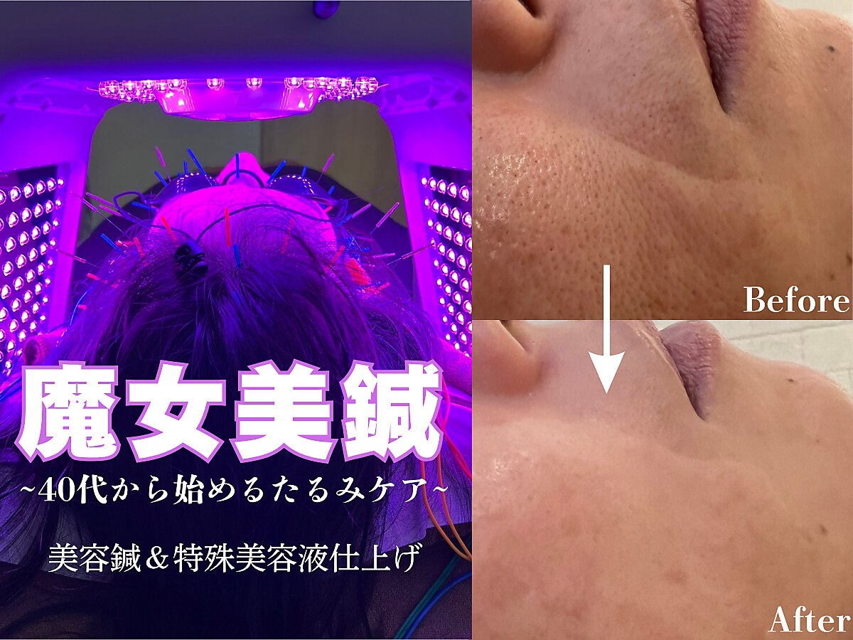 施術シーン：美容鍼灸で肩・首まわりを丁寧にケア